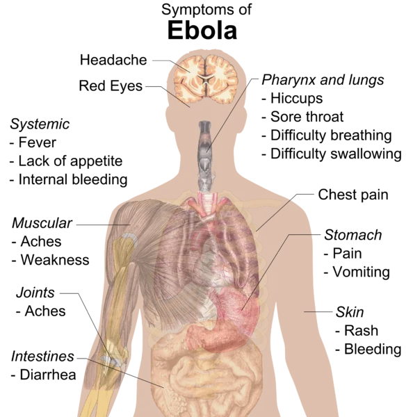 2014 Ebola Outbreak — Medical diagram labeling the symptoms of Ebola virus disease on a human body