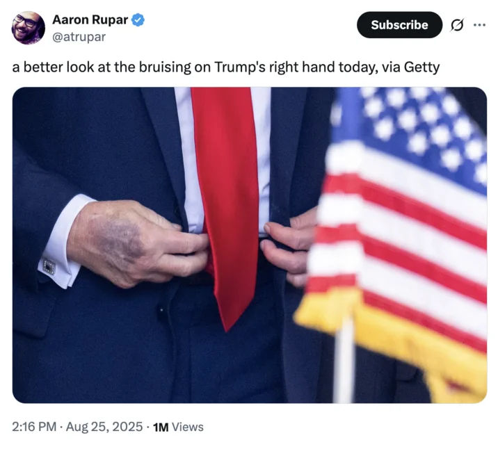 2025 Labor Day Weekend Donald Trump Death Rumor — Close-up photograph of Donald Trump's hand showing visible bruising, catalyst for death rumors.