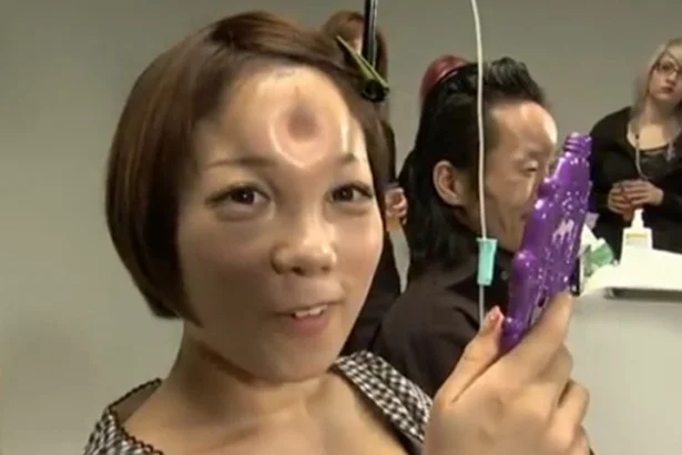 Bagel Heads — Woman with a donut-shaped saline injection bump on her forehead.