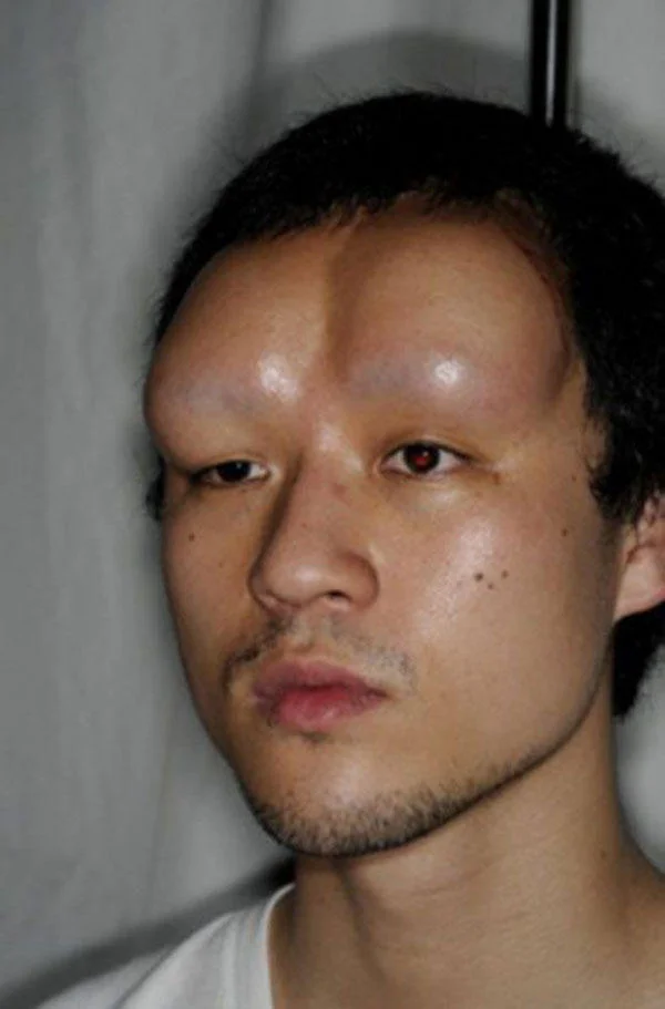 Bagel Heads — Man with two large saline-filled bumps swelling out above his eyebrows.