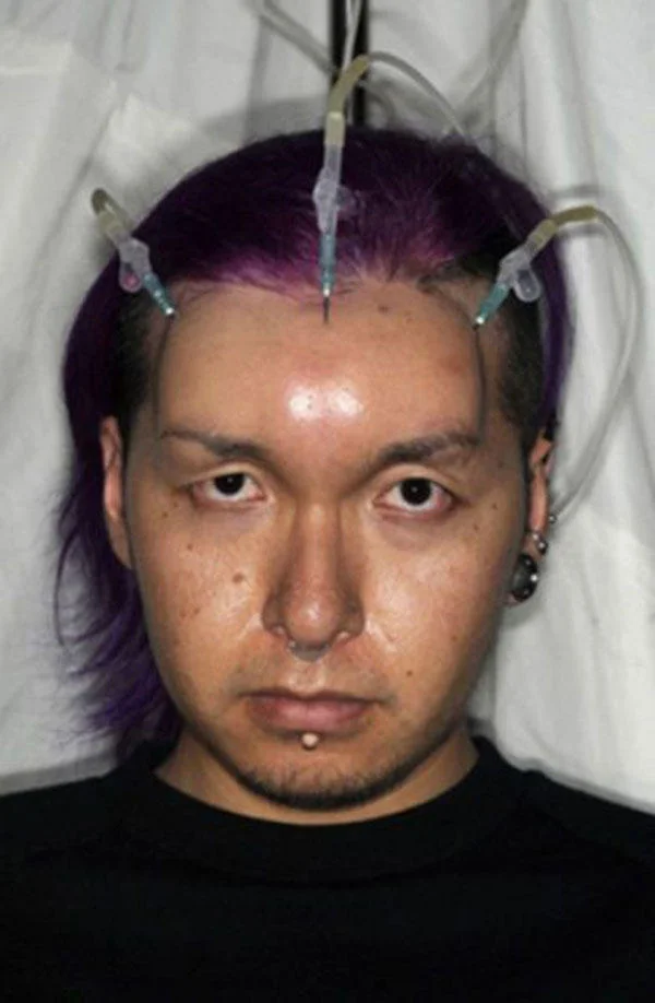 Bagel Heads — Man with purple hair receiving multiple saline injections into his scalp and forehead.