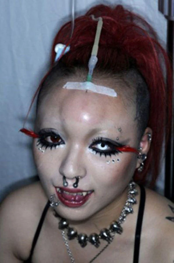 Bagel Heads — Red-haired woman receiving a saline injection on her forehead for a bagel-head effect.