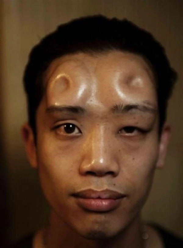 Bagel Heads — Man with two round saline bumps on his forehead resembling small subcutaneous horns.