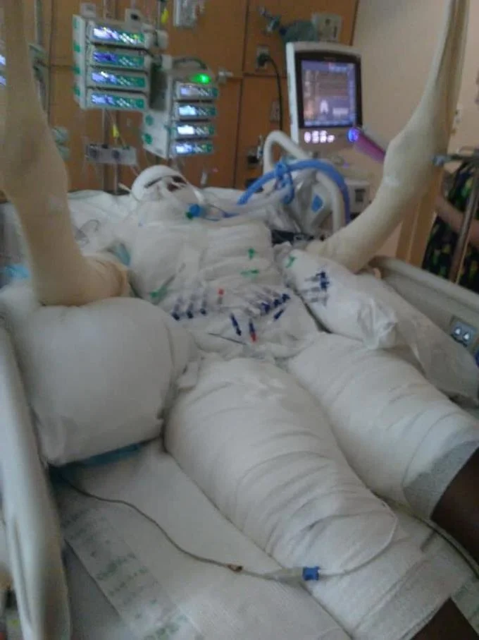 Fire Challenge burn victim wrapped in bandages in an ICU hospital bed with medical monitors and ventilator