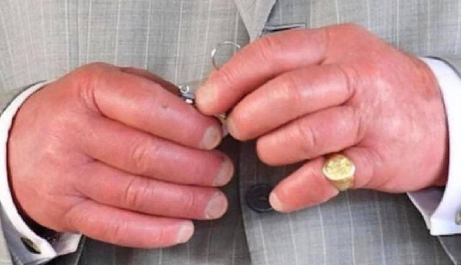 King Charles' Sausage Fingers — Close-up of King Charles' swollen red fingers buttoning a grey suit jacket while wearing a gold signet ring