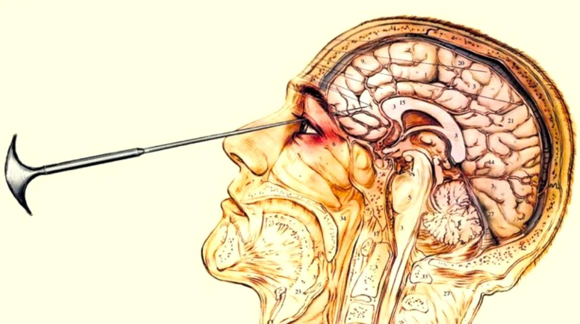 Lobotomy Slang — Medical illustration of transorbital lobotomy procedure showing instrument inserted through eye socket into brain