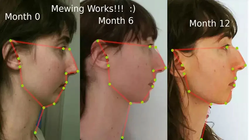 Multi-panel side-profile comparison showing three timepoints labeled 'Month 0,' 'Month 6,' and 'Month 12' with caption 'Mewing Works!!! :)'