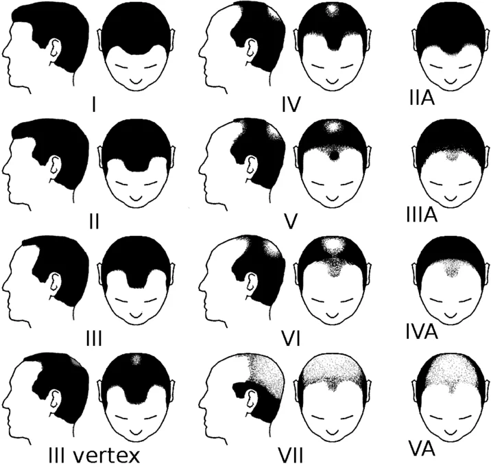 Norwood Scale Norwood Reaper — Hamilton-Norwood Scale medical classification chart showing seven stages of male pattern baldness with side and front views.
