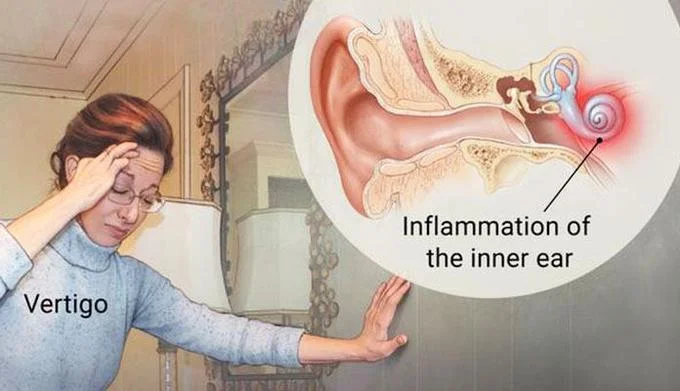 Snail In My Ear Telling Me — Vertigo Inflammation of the inner ear