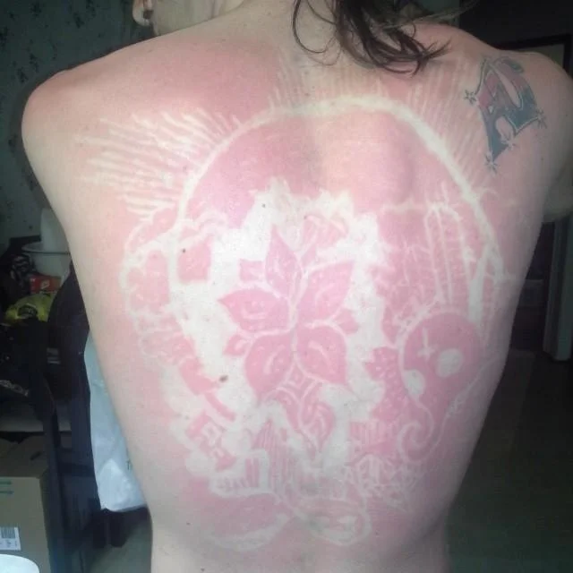 #SunburnArt — Intricate floral sunburn art design covering a person's back.