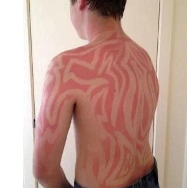 #SunburnArt — Zebra-stripe tribal sunburn art pattern covering a young man's back and torso.